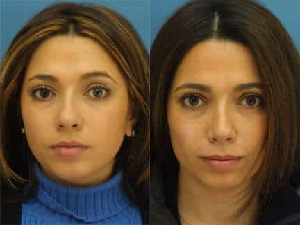 Rhinoplasty to straighten nasal bridge and refine the tip of a female patient by Dr. Miller. Surgery creates symmetry to achieve greater balance with the facial features.