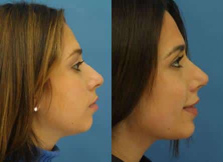 patient-11664-rhinoplasty-nosejob-before-after-3