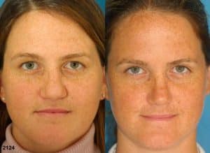 bad nose job correction results in new york city