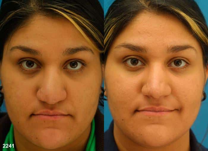 bulbous nose tip rhinoplasty results in new york