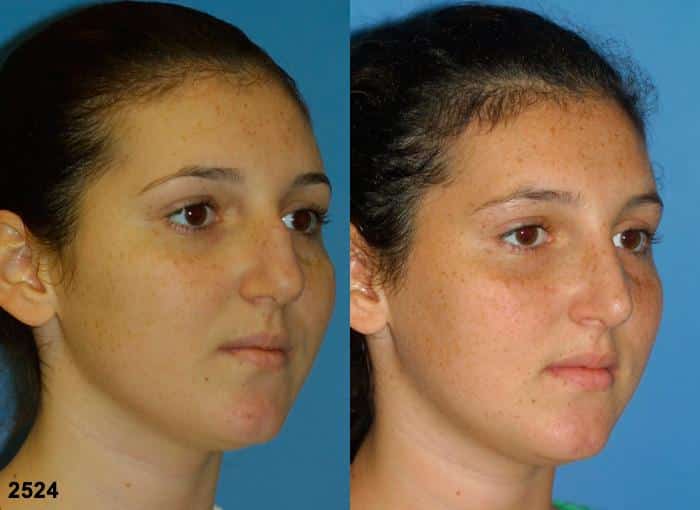 Rhinoplasty to straighten nasal bridge of a female patient by Dr. Miller. Surgery removes small hump from dorsal bridge to improve the patient's facial profile.