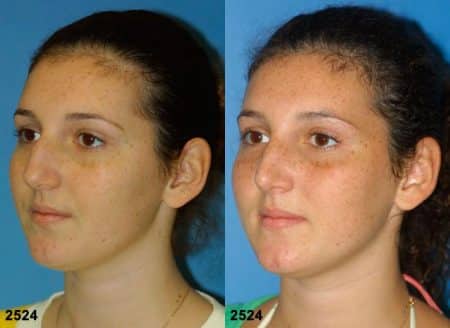 patient-11691-rhinoplasty-nosejob-before-after-4