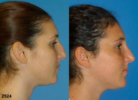 patient-11691-rhinoplasty-nosejob-before-after-5