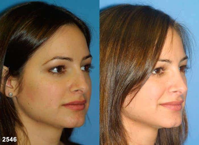 Rhinoplasty to straighten nasal bridge of a female patient by Dr. Miller. After surgery, hump is removed and bridge has more attractive profile.