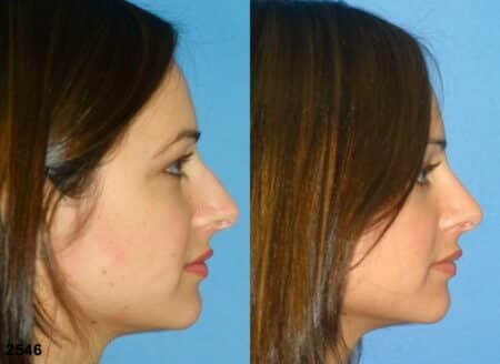 patient-11698-rhinoplasty-nosejob-before-after-5