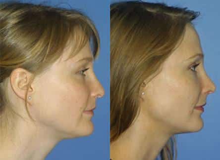 Rhinoplasty to correct nasal bridge and tip of a female patient by Dr. Miller. After surgery, nose has more aesthetically pleasing shape and profile.