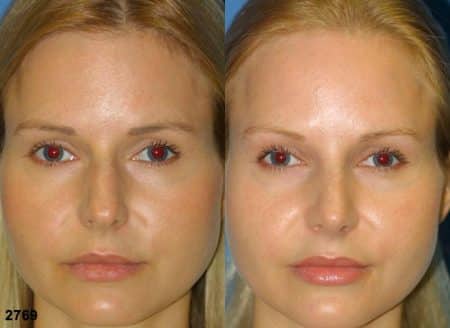 patient-11717-rhinoplasty-nosejob-before-after-3