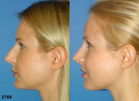 patient-11717-rhinoplasty-nosejob-before-after-5