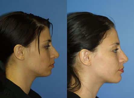 Rhinoplasty to straighten nasal bridge of a female patient by Dr. Miller. Surgery improves facial profile by creating a straighter nasal bridge.