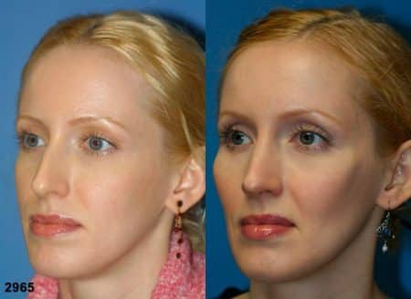 patient-11731-rhinoplasty-nosejob-before-after-4