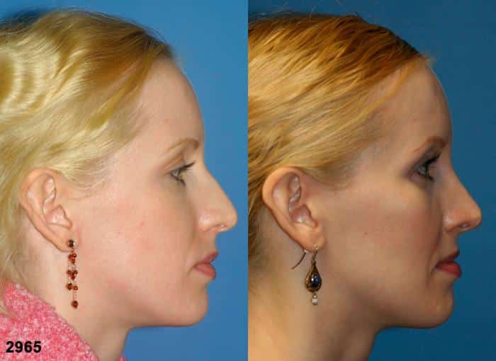 Rhinoplasty to remove dorsal hump and cheek implants to augment midface of a female patient by Dr. Miller. Surgery creates more feminine slope to nasal bridge to enhance the patient's facial profile.