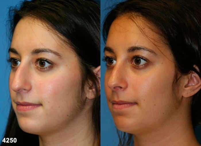 Rhinoplasty to remove dorsal hump and straighten nasal bridge on a female patient by Dr. Miller. Nose is straighter after surgery and tip is slightly rotated to improve patient's facial profile.