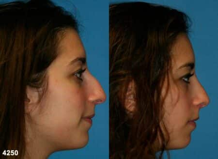 patient-11738-rhinoplasty-nosejob-before-after-3