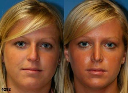 patient-11743-rhinoplasty-nosejob-before-after-3