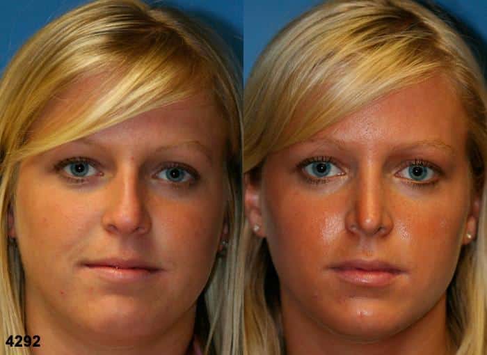 Rhinoplasty to remove a bump from the nasal bridge and enhance the facial contour of a female patient by Dr. Miller. Surgery creates a straighter bridge to produce better proportion and balance to the face overall.
