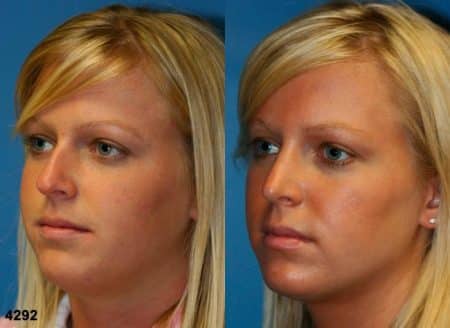 patient-11743-rhinoplasty-nosejob-before-after-4