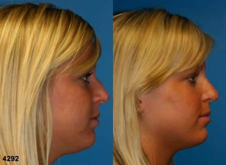 patient-11743-rhinoplasty-nosejob-before-after-5