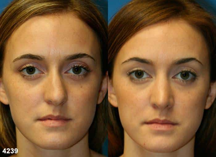 Rhinoplasty to straighten nose of a female patient by Dr. Miller. After surgery, nasal bridge is straight to bring balance and symmetry to the facial contour.