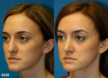 patient-11757-rhinoplasty-nosejob-before-after-4