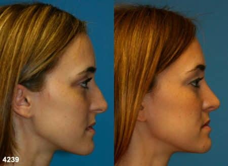 patient-11757-rhinoplasty-nosejob-before-after-5