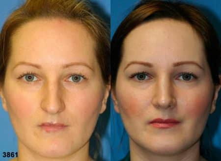 patient-11771-rhinoplasty-nosejob-before-after-2