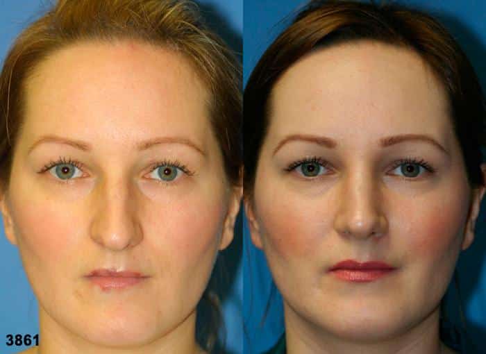 Rhinoplasty to correct nasal bridge and tip of a female patient by Dr. Miller. Surgery straightens bridge and refines nasal tip to create a more aesthetically pleasing facial contour.