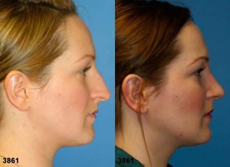 patient-11771-rhinoplasty-nosejob-before-after-3