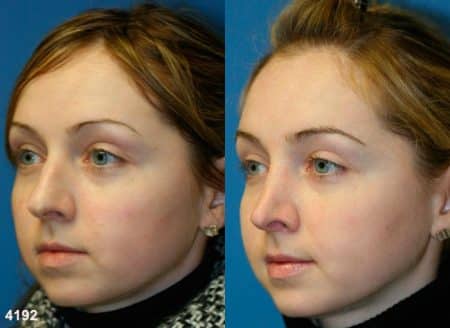 patient-11776-rhinoplasty-nosejob-before-after-4