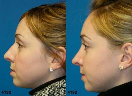 patient-11776-rhinoplasty-nosejob-before-after-5