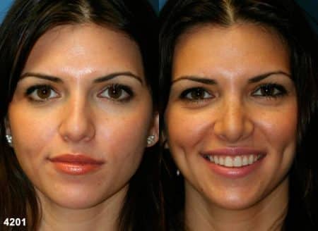 patient-11783-rhinoplasty-nosejob-before-after-3