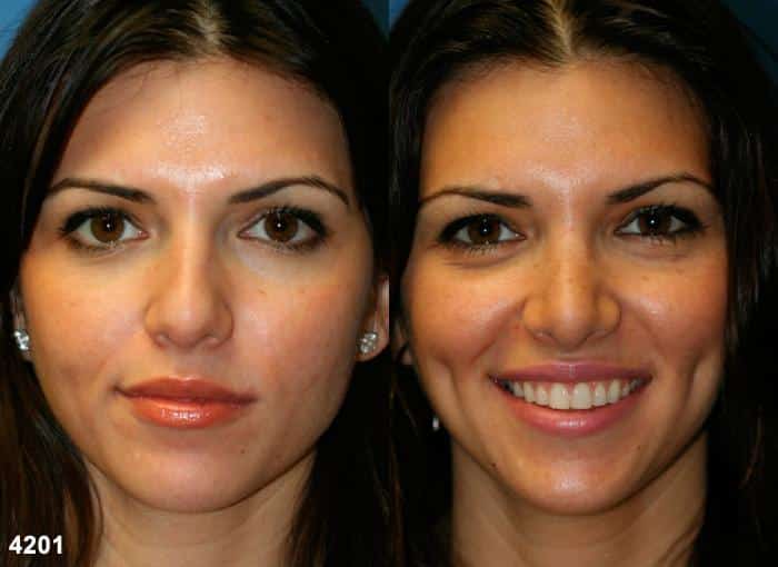 Rhinoplasty to correct a crooked nose of a female patient by Dr. Miller. Straighter nose brings symmetry and balance to facial contour.