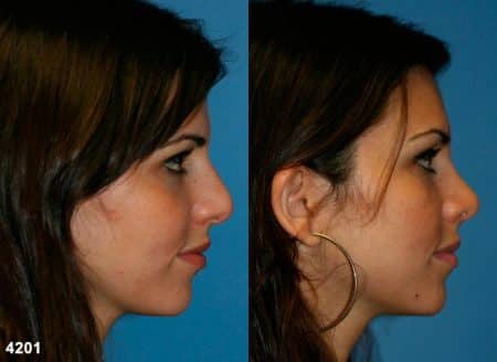 patient-11783-rhinoplasty-nosejob-before-after-5