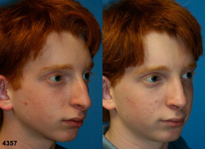 Rhinoplasty to straighten nasal bridge of a male patient by Dr. Miller. Surgery removes dorsal hump and refines nasal tip to improve the profile.