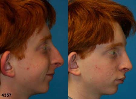 patient-11790-rhinoplasty-nosejob-before-after-5