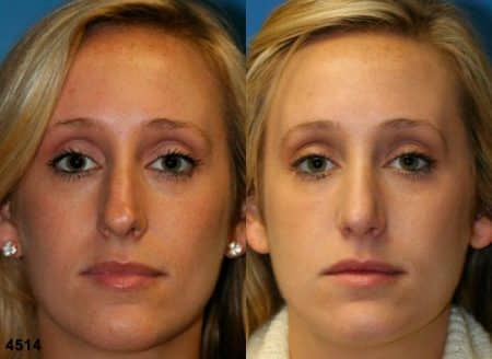 patient-11797-rhinoplasty-nosejob-before-after-3