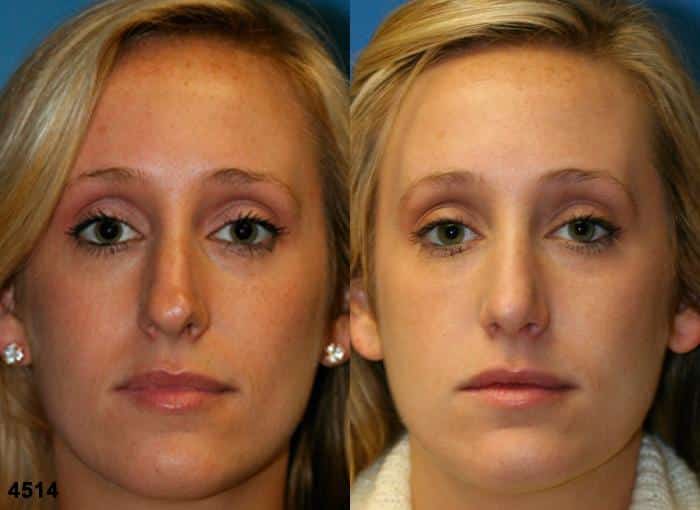 Rhinoplasty to straighten nasal bridge of a female patient by Dr. Miller. As nose is straightened, facial contour becomes more symmetrical and balanced.