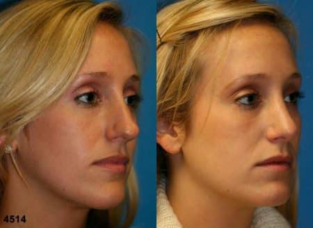 patient-11797-rhinoplasty-nosejob-before-after-4