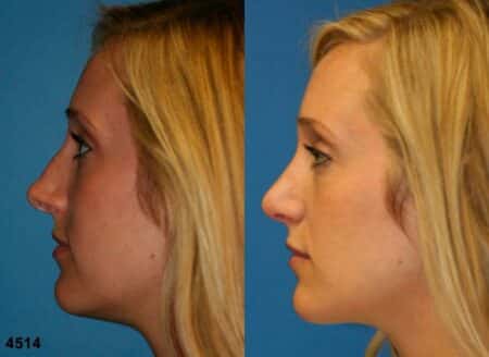 patient-11797-rhinoplasty-nosejob-before-after-5