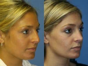 Rhinoplasty Patient Before and After New York