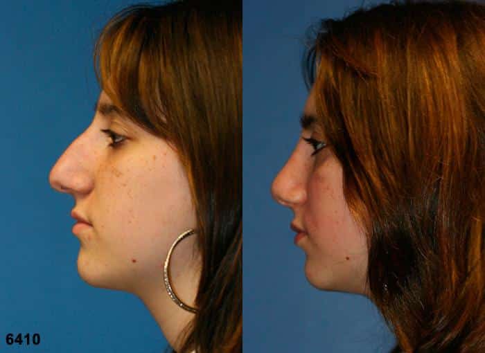 Rhinoplasty to straighten nasal bridge and refine the tip of a female patient by Dr. Miller. Surgery creates a smaller, straighter nose shape for a more feminine facial profile.