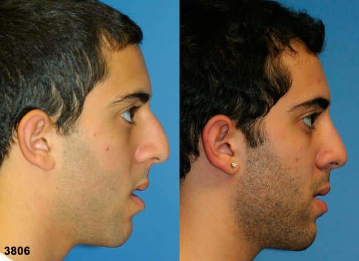 Rhinoplasty to straighten nasal bridge and refine the tip of a male patient by Dr. Miller. Dorsal bridge is straighter and tip droopiness is corrected after surgery.