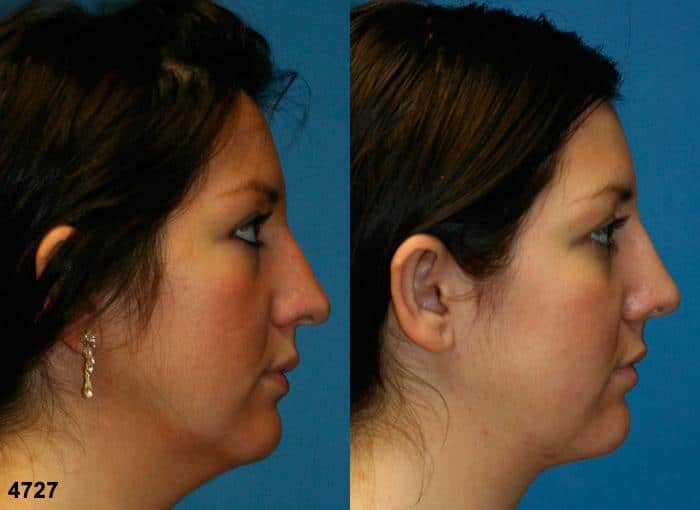 Rhinoplasty to straighten nasal bridge and liposuction to remove the submental fat of a female patient by Dr. Miller. Nose is straighter after surgery and tip is refined to create a more aesthetically pleasing facial profile.