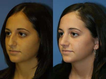Rhinoplasty to correct nasal bridge and tip of a female patient by Dr. Miller. Surgery creates straighter nasal bridge to improve the profile of the nose.