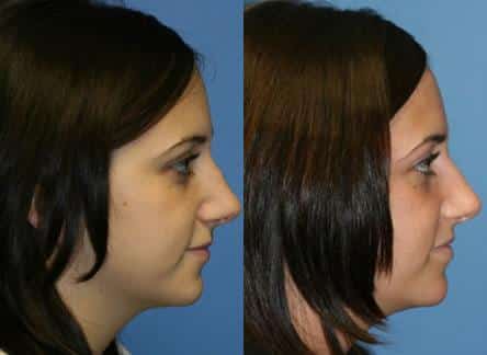 patient-11835-rhinoplasty-nosejob-before-after-3