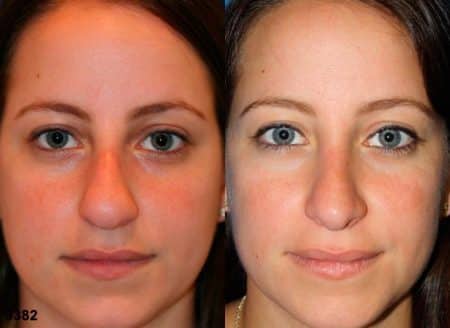 patient-11840-rhinoplasty-nosejob-before-after