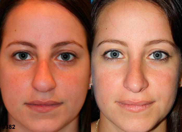 Rhinoplasty to correct nasal bridge and tip of a female patient by Dr. Miller. Surgery refines tip and straightens bridge to create a more aesthetically pleasing facial contour.