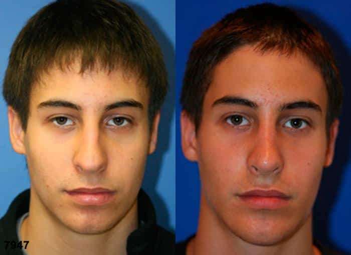 Rhinoplasty to refine the nasal tip and implant to augment chin on a male patient by Dr. Miller. After surgery, tip is less droopy and chin is stronger to improve the facial contour.