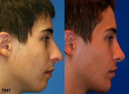 patient-11847-rhinoplasty-nosejob-before-after-6