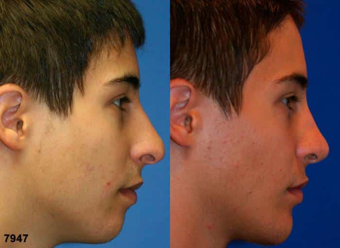 Rhinoplasty to refine the nasal tip and implant to augment the chin of a male patient by Dr. Miller. Surgery eliminates the drooping tip and strengthens the chin to improve the patient's facial profile.