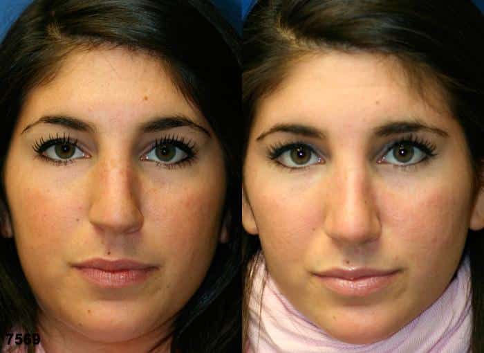 Rhinoplasty to straighten nasal bridge of a female patient by Dr. Miller. Surgery corrects nasal bridge while maintaining a positive facial contour from the front.